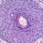 FOKUS – Metastazat e kancerit nuk janë qeliza të ”çmendura”, por ndjekin një plan arkitektonik